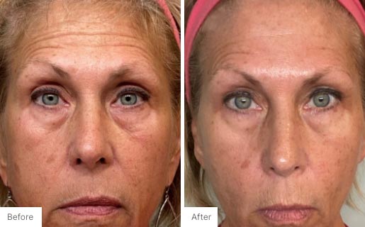 1 - Before and After Real Results photo of a woman's face.